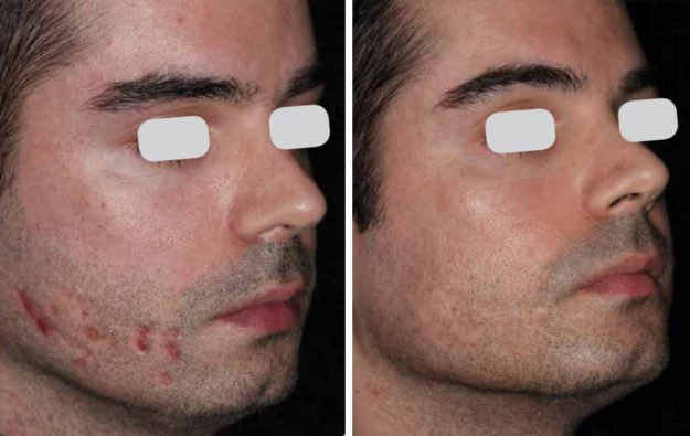 acne-littekens-2